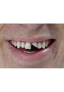 Missing Tooth Cosmetic Wax